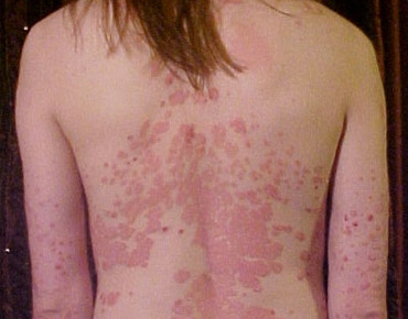 Childhood Illnesses
