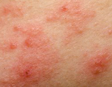 Childhood Infections