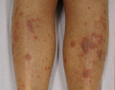 Children Vaccinations / Immunisations